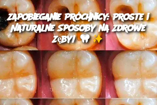 Zapobieganie Próchnicy: Proste i Naturalne Sposoby na Zdrowe Zęby!