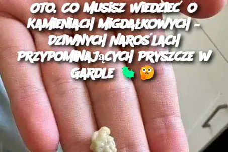 Oto, Co Musisz Wiedzieć o Kamieniach Migdałkowych – Dziwnych Naroślach Przypominających Pryszcze w Gardle