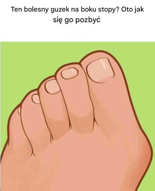 Ten bolesny guzek na boku stopy? Oto jak się go pozbyć