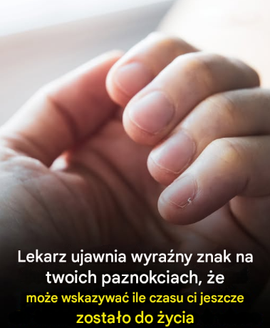 Lekarz ujawnił wyraźny znak na twoich paznokciach, który może wskazywać, ile czasu ci jeszcze zostało do życia Artykuł w pierwszym komentarzu